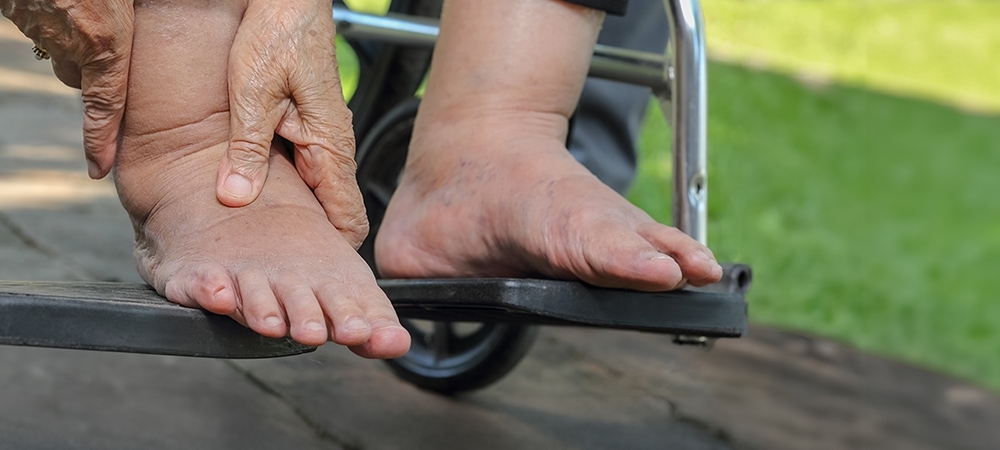 Ödem neden olur? Ödem nasıl atılır?