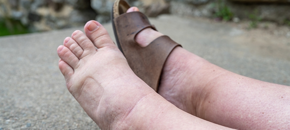 Ödem ne demek? Vücuttaki ödem nasıl atılır?