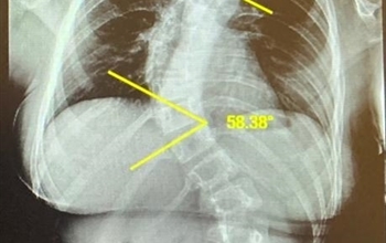 Hızlı Boy Atma Skolyoz Nedeni Olabilir 
