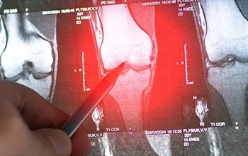 Osteokondrom nedir? Osteokondrom neden oluşur?