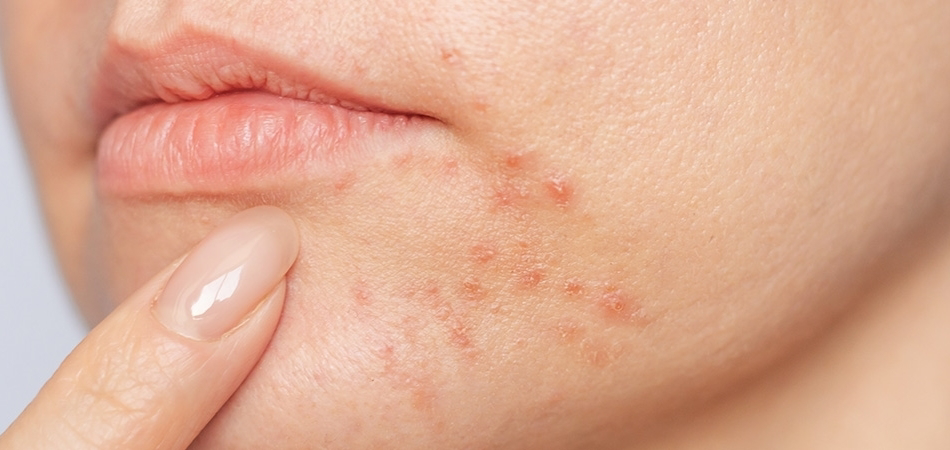 Perioral dermatit nedir? Perioral dermatit belirtileri, nedenleri ve tedavisi