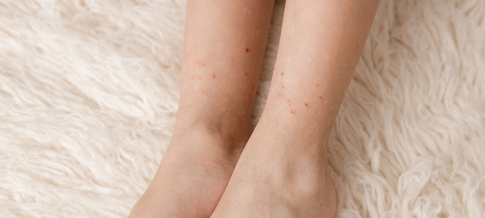 Pire ısırığı nasıl geçer? Pire ısırığının belirtileri nelerdir?