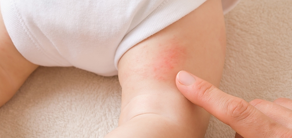 Pişik en çabuk nasıl geçer? Pişik neden olur?