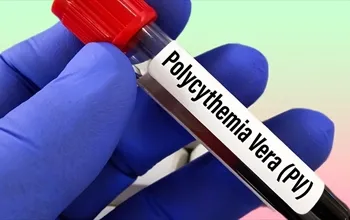 Polisitemi vera: Nedenleri, belirtileri ve tedavi yaklaşımları