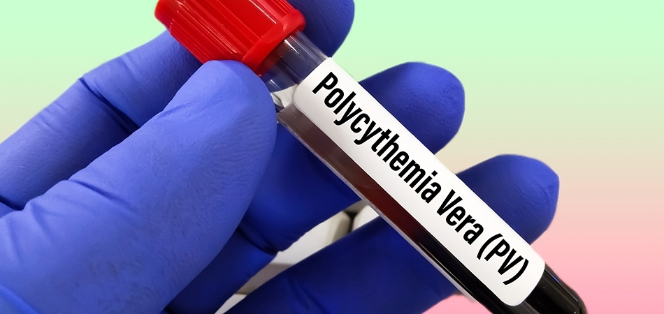 Polisitemi vera: Nedenleri, belirtileri ve tedavi yaklaşımları