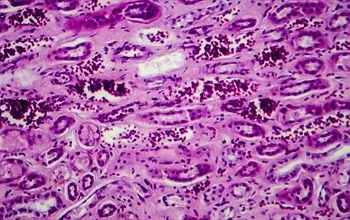 Proliferatif ne demek? Proliferatif hastalık nedir?