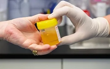 Proteinüri ne demek? Protein yüksekliğinin belirtileri nelerdir?