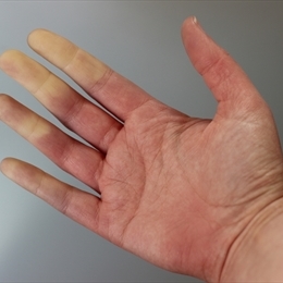 Raynaud Hastalığı