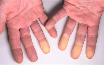 Raynaud sendromu nedir? Nedenleri, belirtileri ve doktora başvuru zamanı