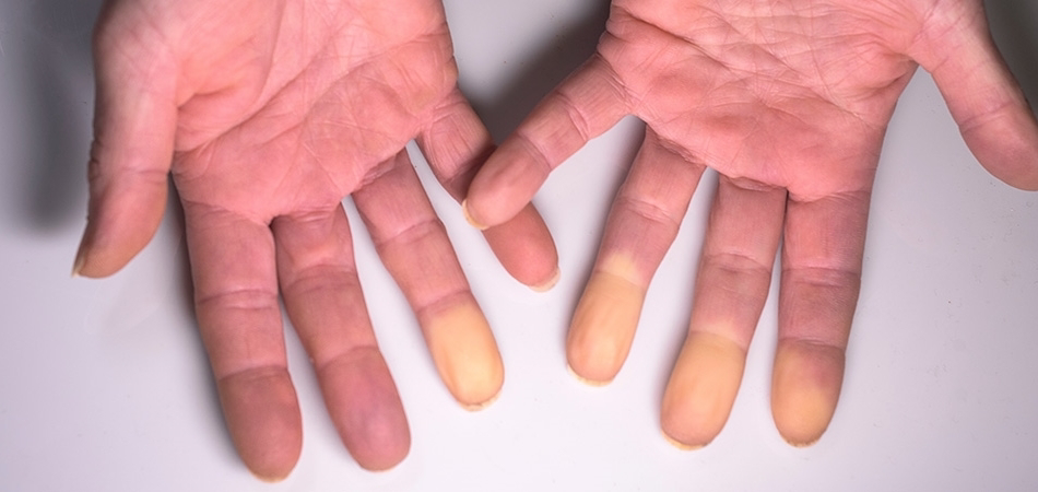 Raynaud sendromu nedir? Nedenleri, belirtileri ve doktora başvuru zamanı