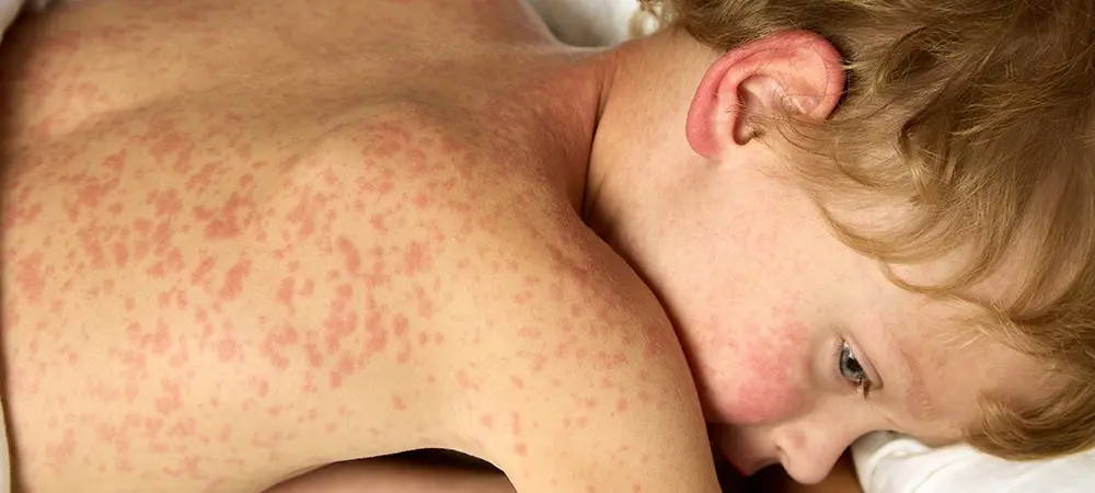 Rubella (Kızamıkçık) nedir? Rubellanın belirtileri neler? Rubella (Kızamıkçık) nedir? Rubellanın belirtileri neler?