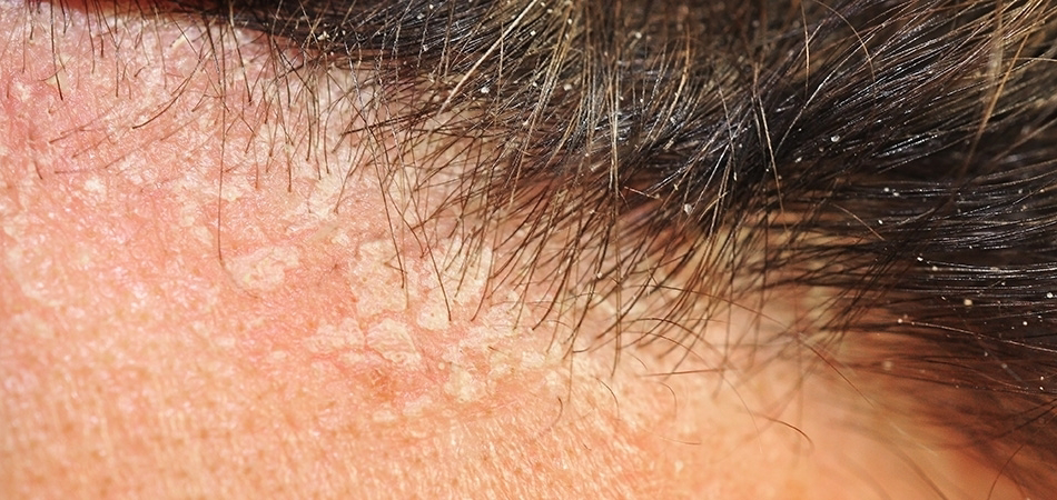 Saç derisinde kabuklanma nasıl geçer? Kabuk tutan saça ne iyi gelir?