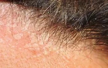 Saç derisinde kabuklanma nasıl geçer? Kabuk tutan saça ne iyi gelir?