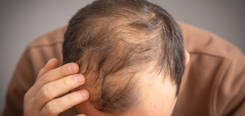 Saç dökülmesine ne iyi gelir? Saç dökülmesine bitkisel çözüm önerileri