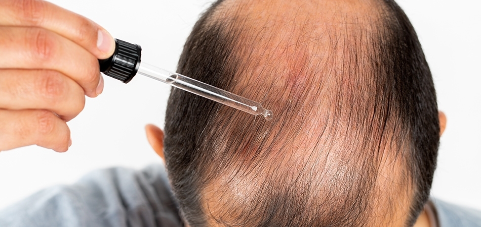 Saç dökülmesine iyi gelen yağlar nelerdir? Saç dökülmesini en hızlı ne durdurur?