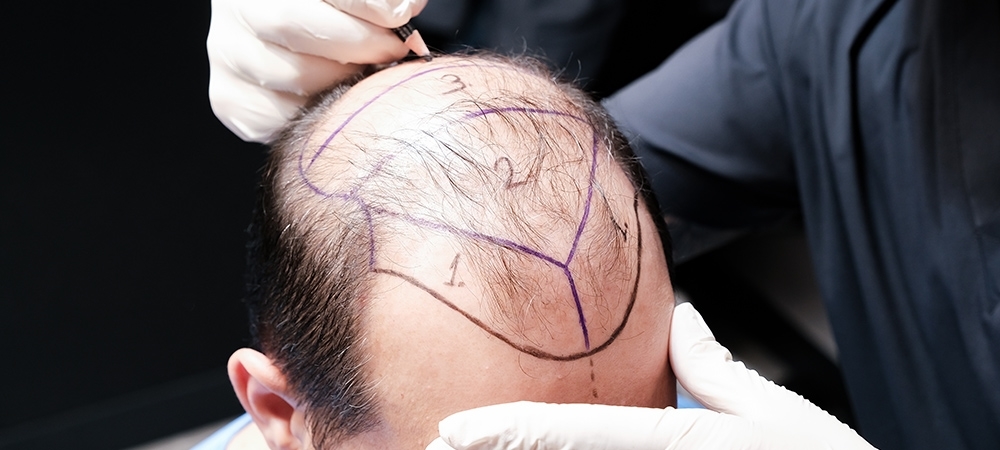 Kimler saç ekimi yaptırabilir? Saç ekiminin riskleri nelerdir?