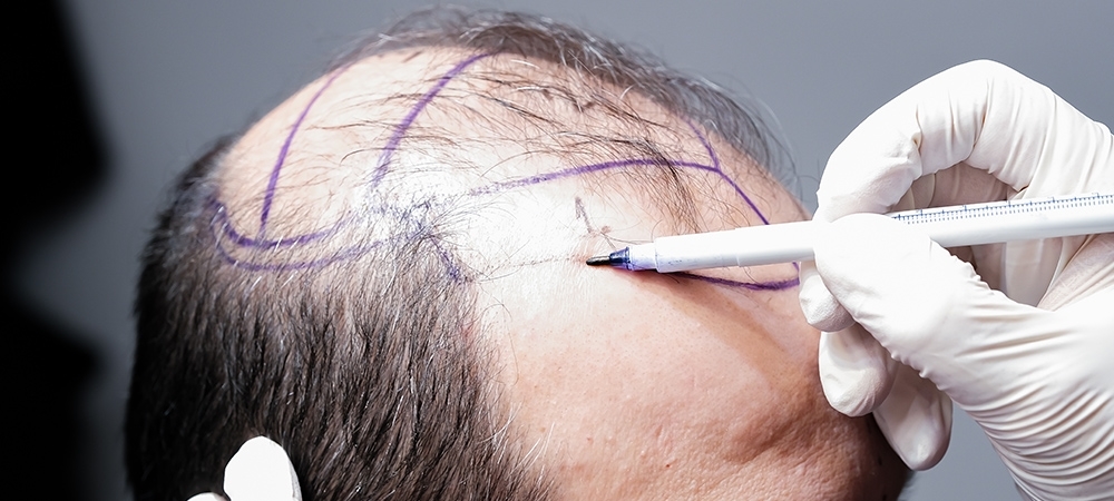 Saç ekimi yöntemleri neler? Ekilen saç kaç yıl dayanır?