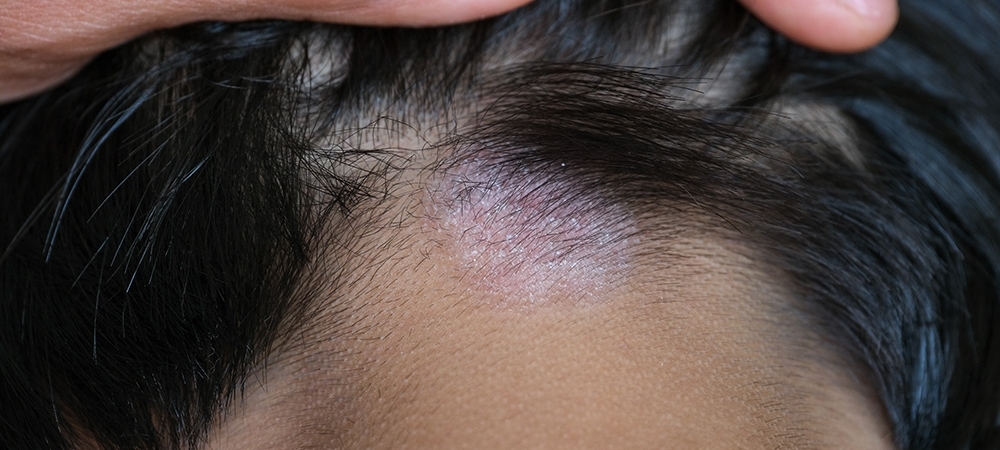 Saç mantarı nedir? Saç mantarı neden olur?