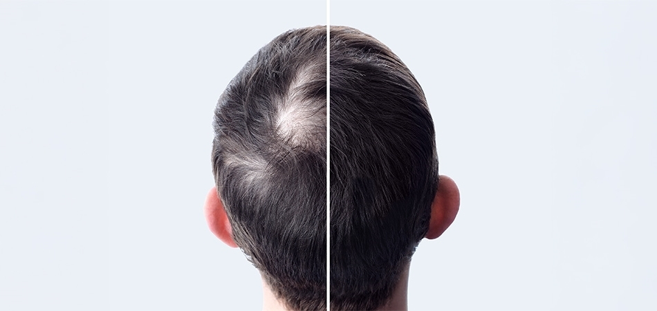 Saçı en çok ne gürleştirir? Saç derisini ne güçlendirir?