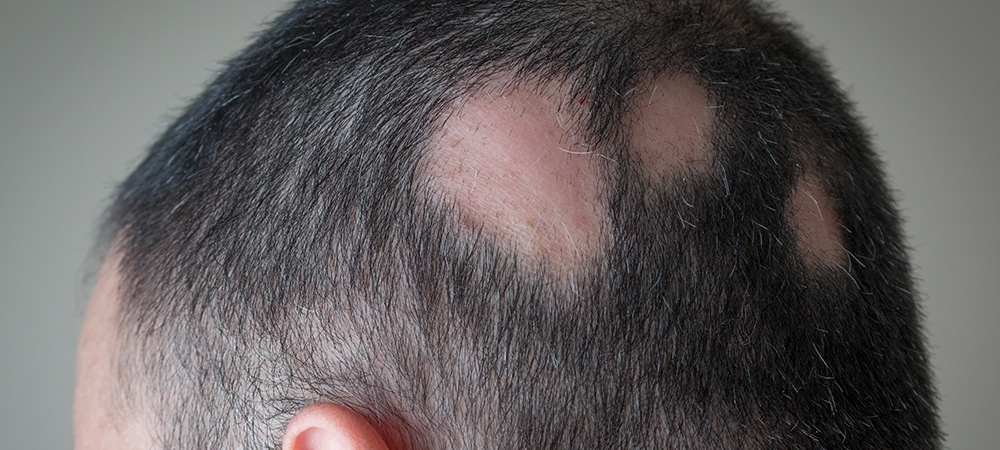 Saçkıran neden olur? Saçkıran belirtileri nelerdir?