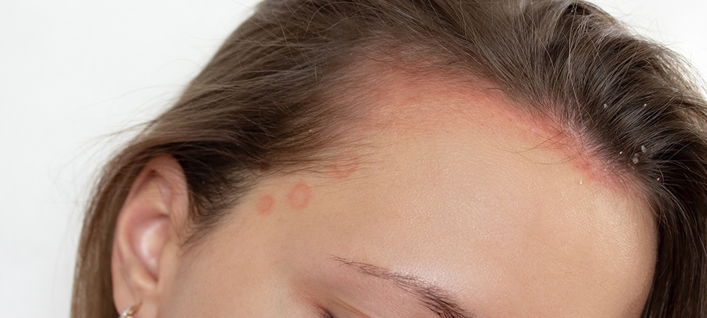 Saçtaki sedef neden olur? Saçta sedef olduğu nasıl anlaşılır?