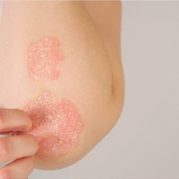 Sedef Hastalığı (Psoriasis) Nedir?