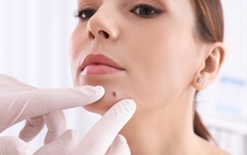 Deride Ortaya Çıkan Benler Risk Oluşturabiliyor