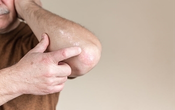 Mantar, Kardiyovasküler Rahatsızlıkları Olan Bireylerde Daha Sık Görülüyor