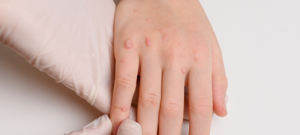 Siğil nedir? Siğil belirtileri nelerdir?