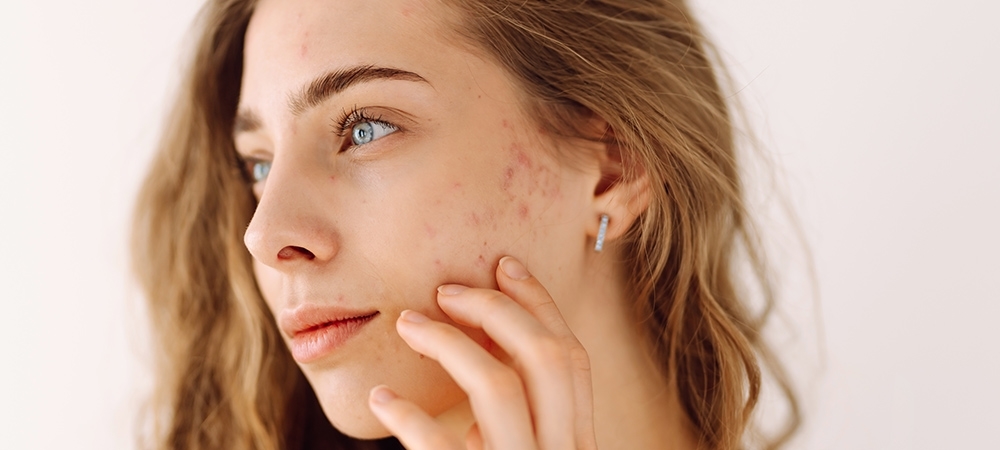 Sivilce izlerine ne iyi gelir? Sivilce izlerine iyi gelen günlük bakım rutinleri