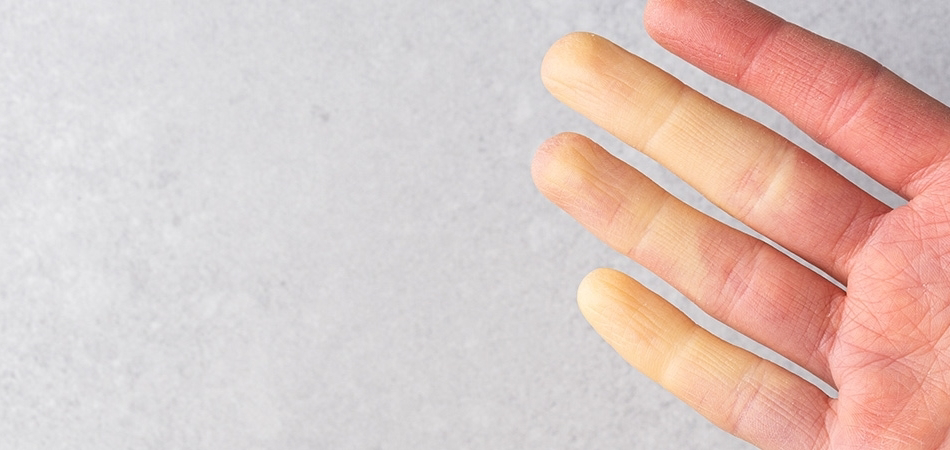 Skleroderma nedir: Belirtileri, tanı yöntemleri ve tedavi seçenekleri
