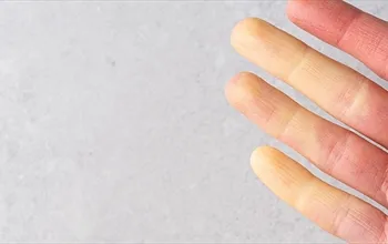 Skleroderma nedir: Belirtileri, tanı yöntemleri ve tedavi seçenekleri