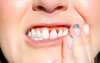 Skorbüt hastalığı nedir? Skorbüt belirtileri nelerdir?