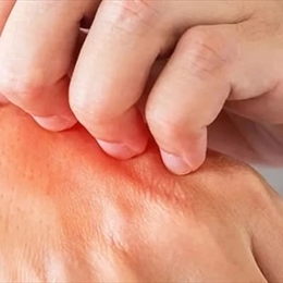 Soğuk Isırması