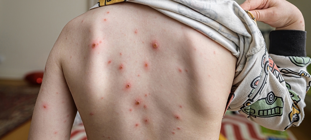 Suçiçeği nedir? Suçiçeği hastalığı kaç gün sürer?