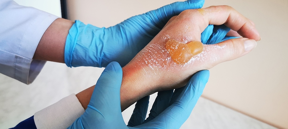 Su toplamış yanığa ne iyi gelir? Yanık izi nasıl geçer?