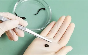 Sülük tedavisi nedir? Sülük tedavisi ne işe yarar?