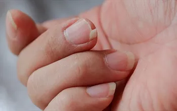Tırnak kırılmasının nedenleri neler? Tırnak kırılmasına ne iyi gelir?