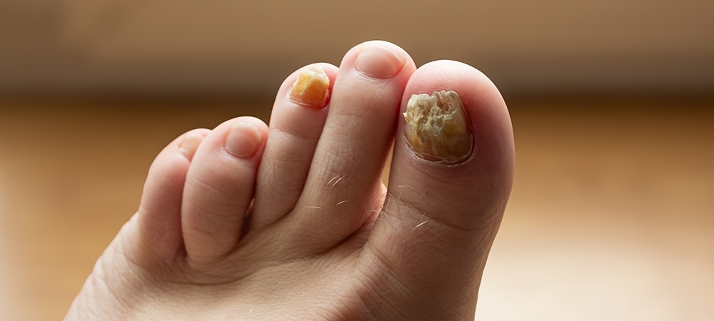 Tırnak mantarı en çabuk nasıl geçer? Tırnak mantarının belirtileri nelerdir?