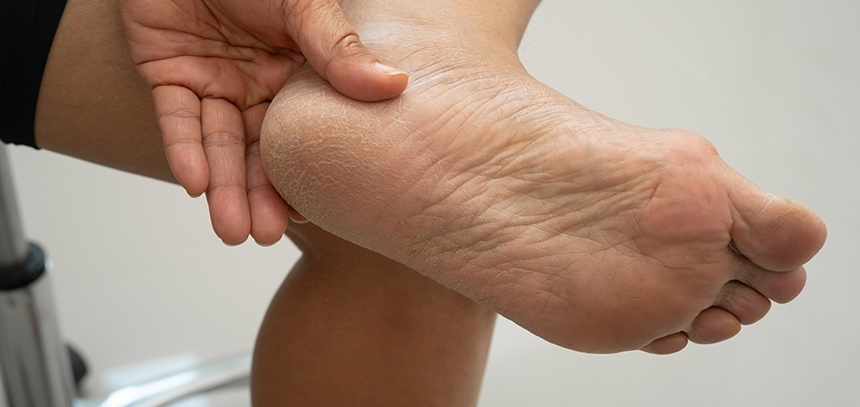 Topuk çatlağı en hızlı nasıl geçer? Topuk çatlaklarına hangi krem iyi gelir?