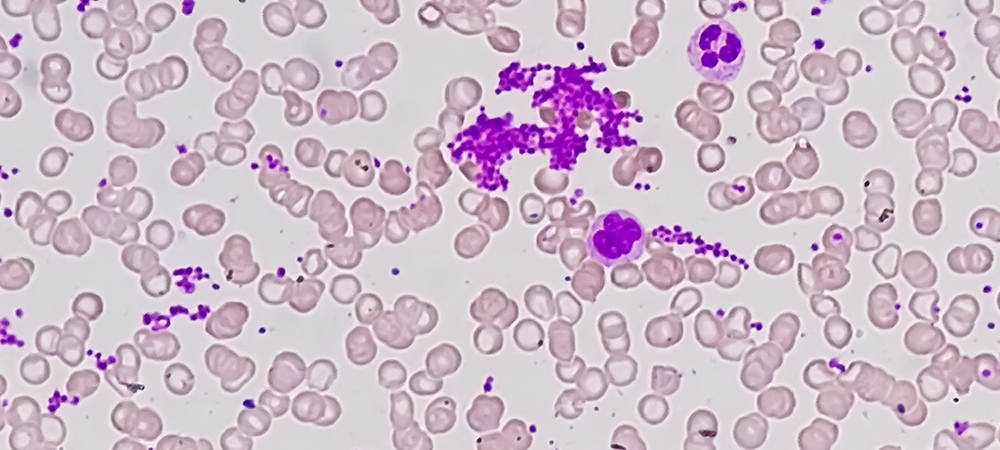 Trombosit (PLT) nedir? Trombosit yüksek olması ne demek?