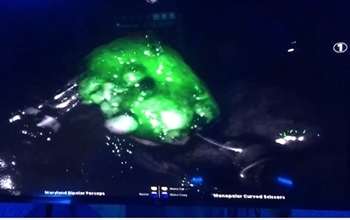 Tümör ihtimaline yeşil müdahale