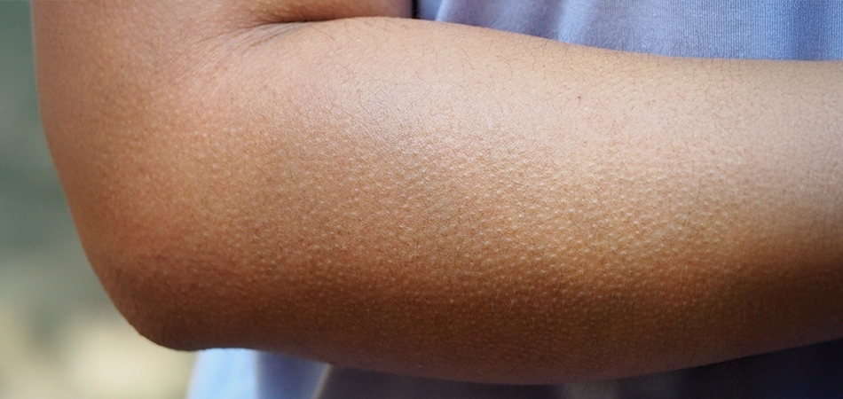 Tüylerin diken diken olması neden olur? Tüyler neden ürperir?