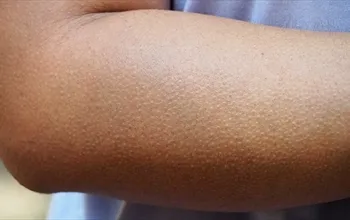 Tüylerin diken diken olması neden olur? Tüyler neden ürperir?