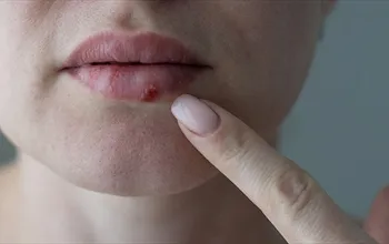 Uçuk izi nasıl geçer? Uçuk izine hangi kremler iyi gelir?