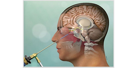 Görme kaybı ve geçmeyen baş ağrısı hipofiz tümörünün habercisi olabilir