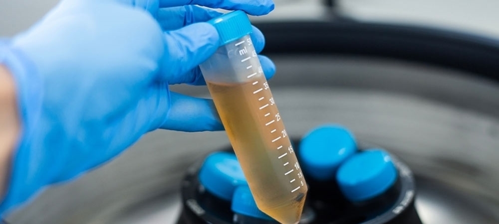 Üre nedir? Üre yüksekliği/düşüklüğü ne anlama gelir?