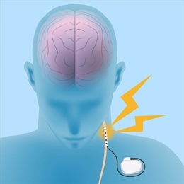 Vagal Sinir Stimülatörü (VNS) Nedir?