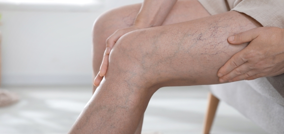 Varis tedavisi nedir? Varis nasıl geçer?