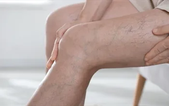 Varis tedavisi nedir? Varis nasıl geçer?